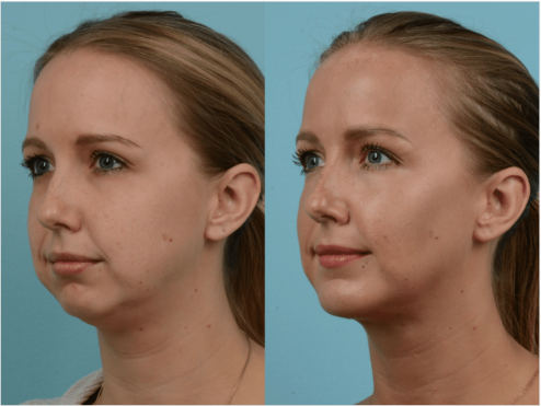 Buccal fat removal