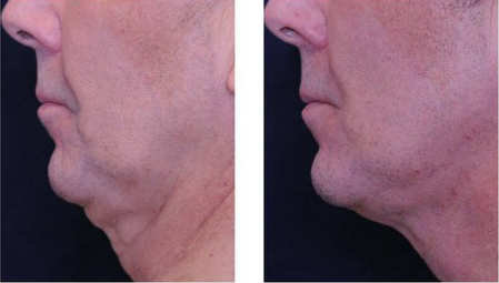 Profound treatment on double chin