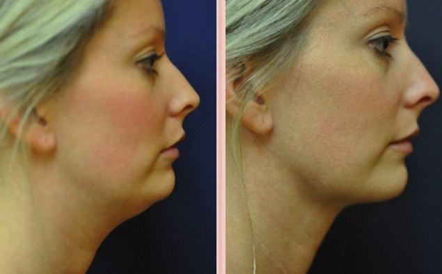 Vaser liposuction for double chin and saggy neck