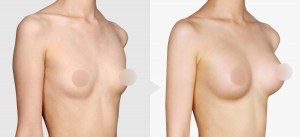 breast implant, breast augmentation