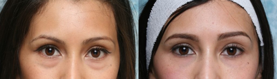 scarless eyebag surgery