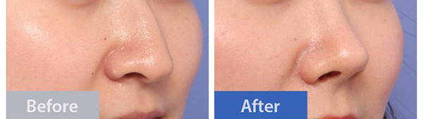 tip-plasty nose implant