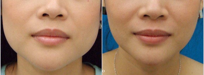 buccal fat removal surgery