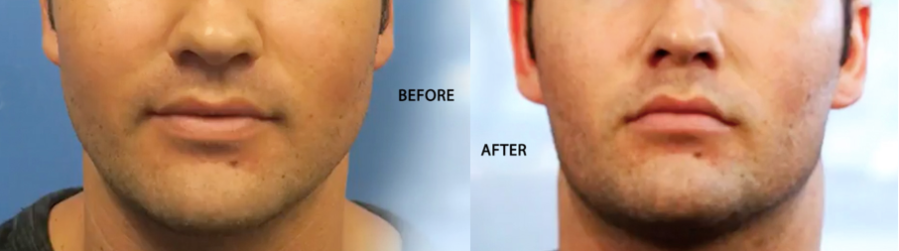 facial slimming with buccal fat removal surgery