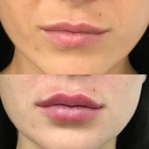 natural lip shape fillers